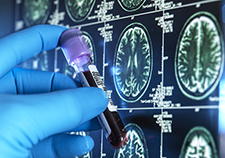 Head trauma, PTSD may increase genetic variant's impact on Alzheimer's risk